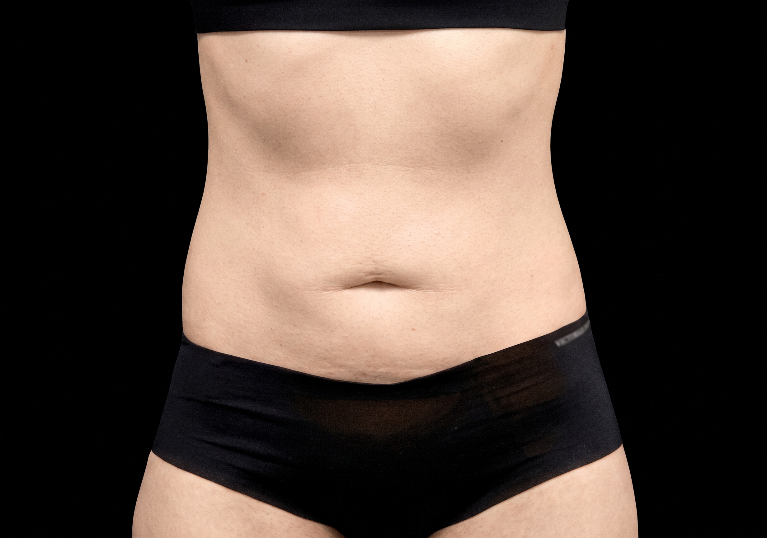 Emsculpt Neo after