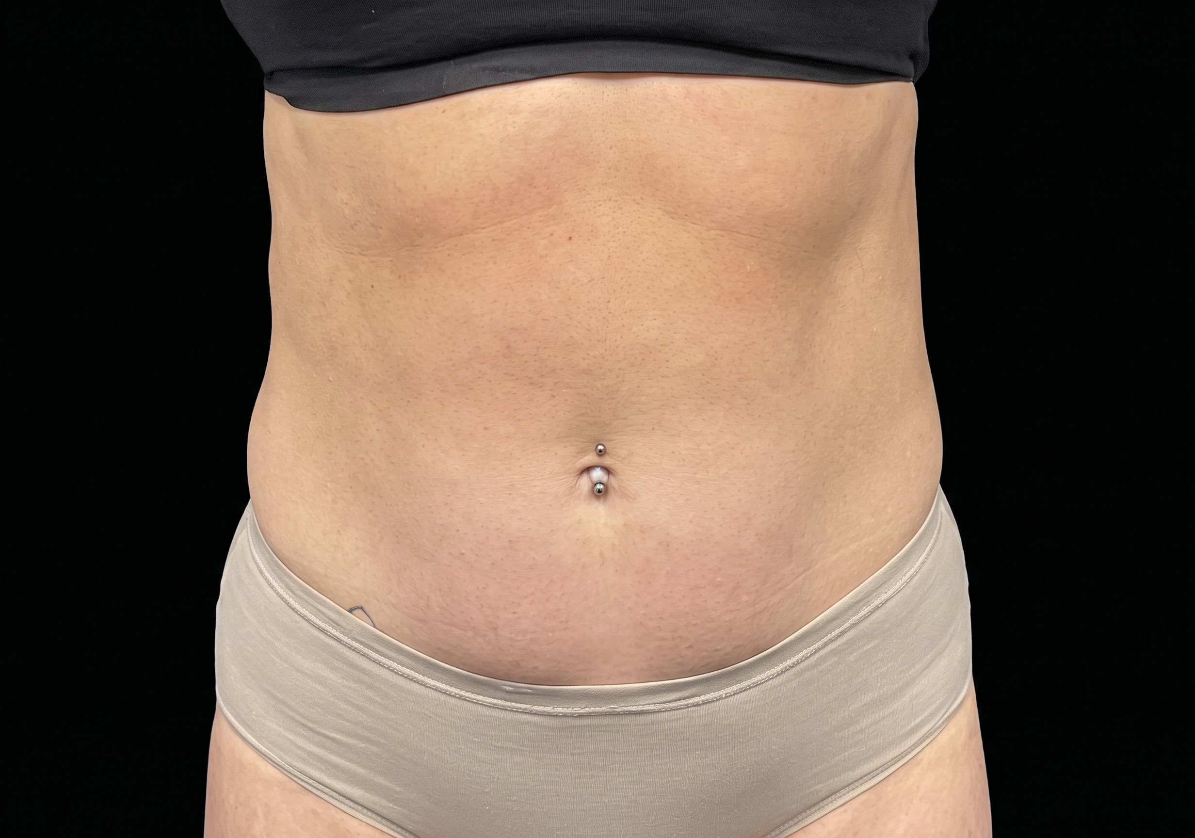 Emsculpt Neo after