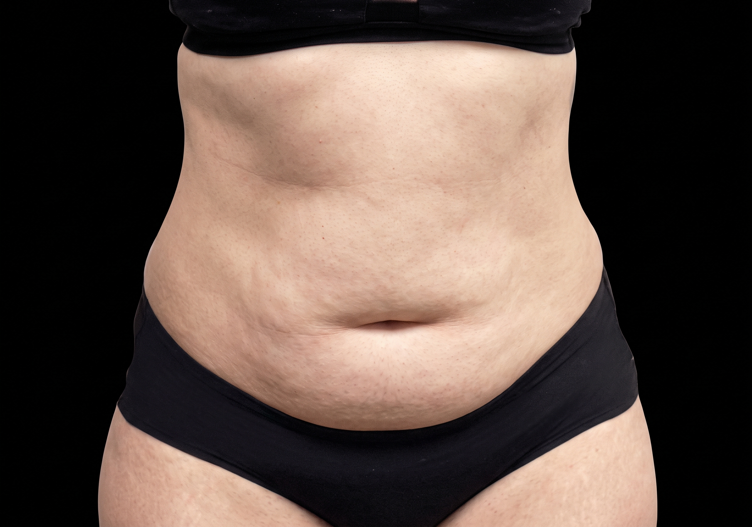 Emsculpt Neo before