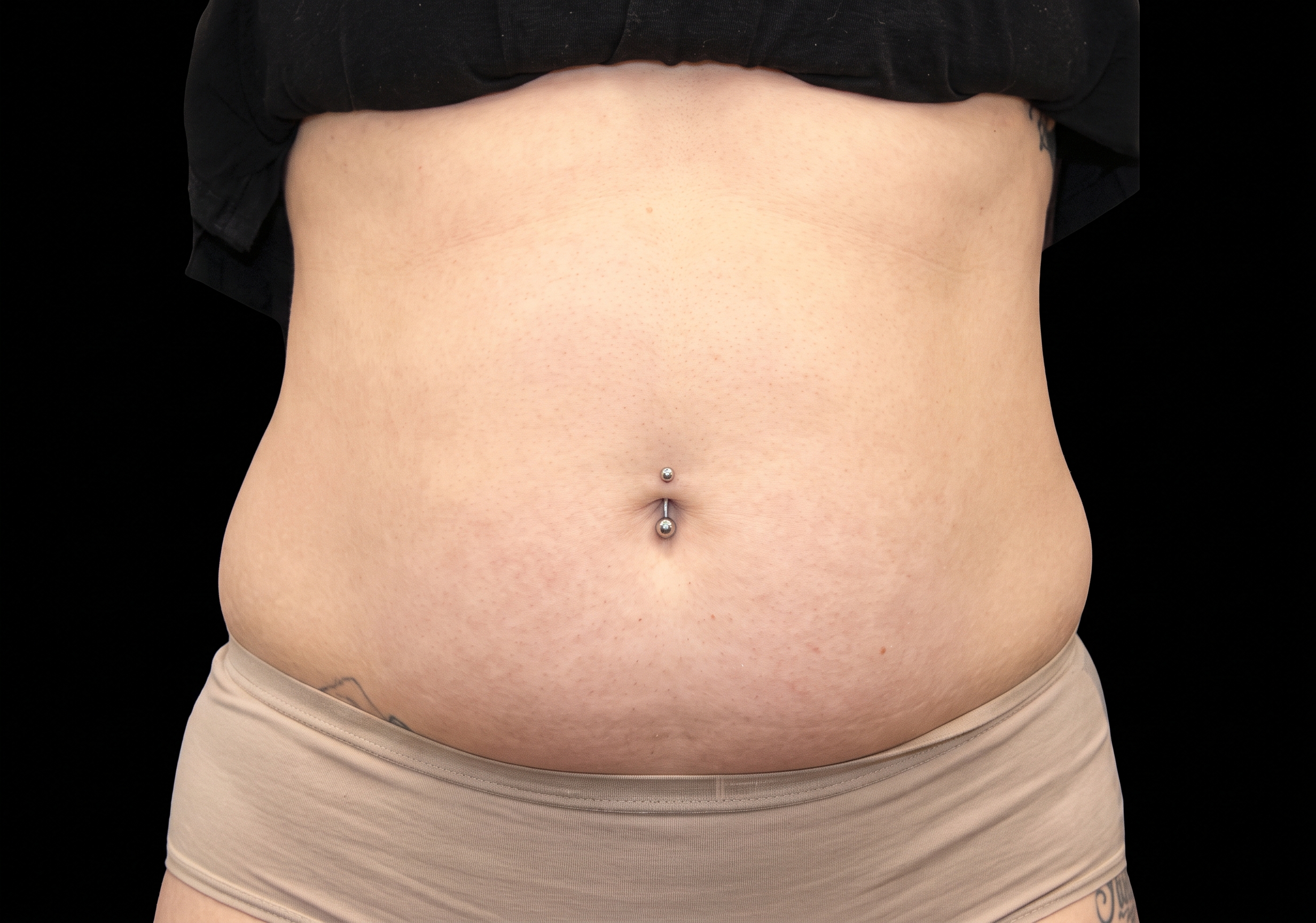 Emsculpt Neo before
