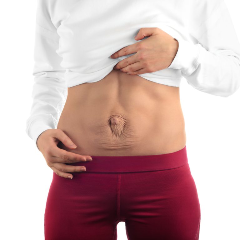 woman post-pregnancy dealing with diastasis recti in DC